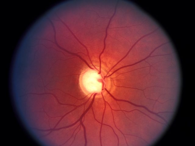 Glaucoma