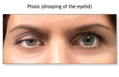 ptosis