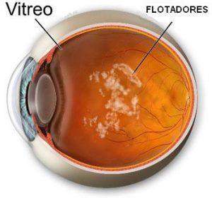 vitrea