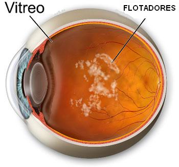 vitrea