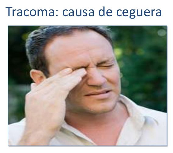 tracoma