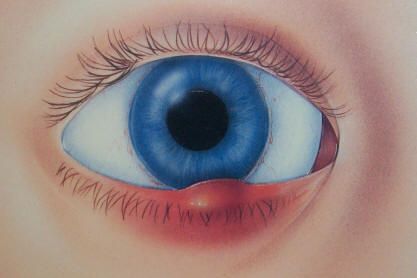 chalazion
