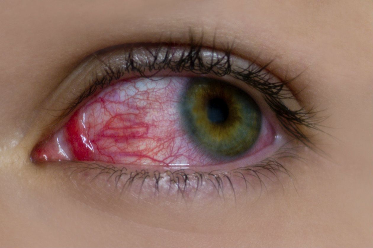 ojo rojo