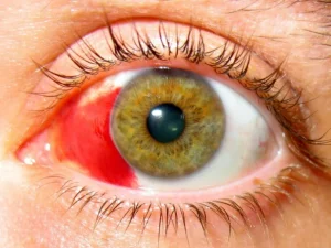 Hemorragia subconjuntival Óptica Baca Ronda