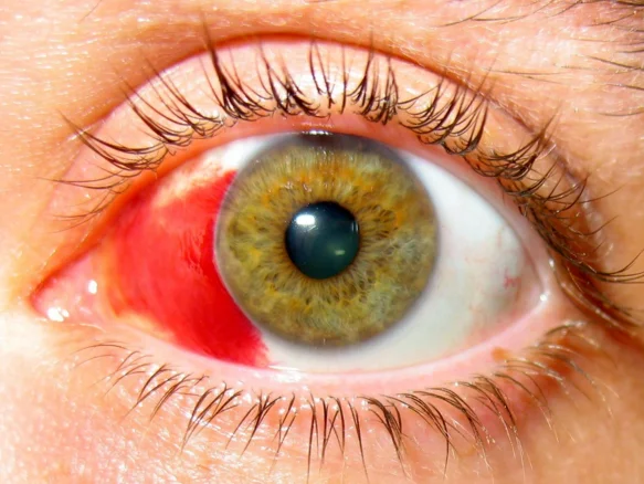 Hemorragia subconjuntival Óptica Baca Ronda